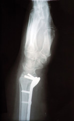 X-ray bones human hand with titanium plate