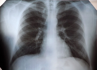 X-ray human lung 