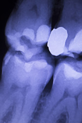 Tooth filling dental xray