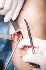 Surgical operation knee surgery