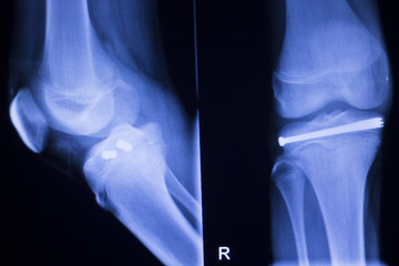 Knee joint implant xray
