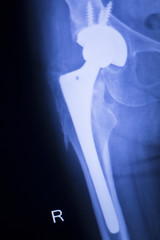 Hip joint replacement xray