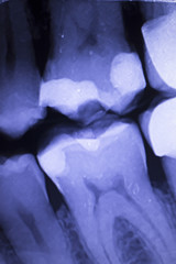 Tooth filling dental xray