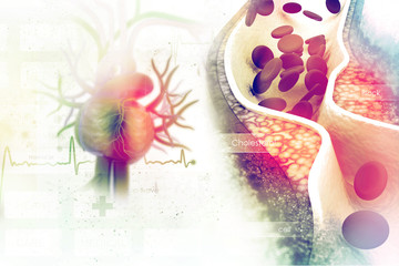 Cholesterol plaque in artery