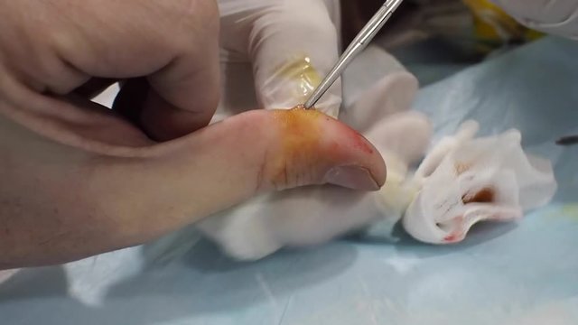 Surgery of the thumb of the hand with instruments closeup