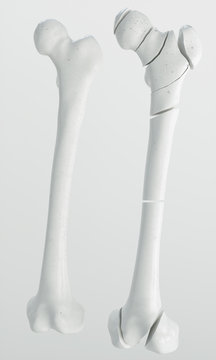Fracture of the femur - breakpoints - 3D Rendering