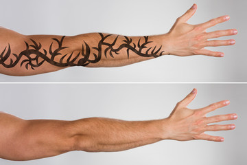 Laser Tattoo Removal Before And After