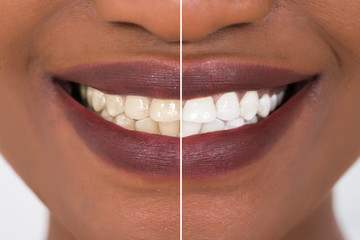 Woman Teeth Before And After Whitening