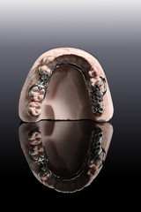 partial denture upper arch