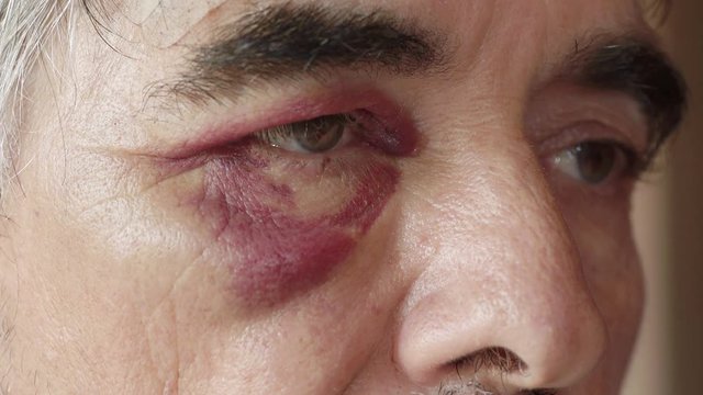 black eyes of middle age boxer after fight