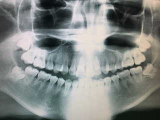X-ray scan of humans teeth

