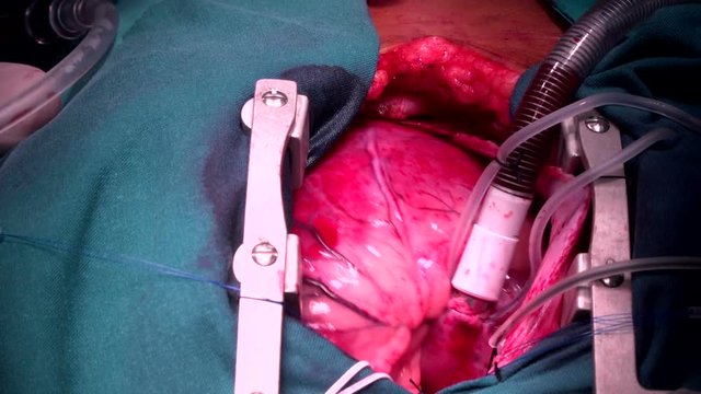 open heart surgery