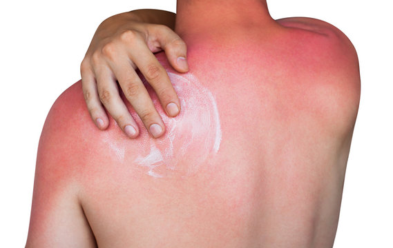A man with reddened itchy skin after sunburn, smears cream on the skin. Skin care and protection from the sun's ultraviolet rays.