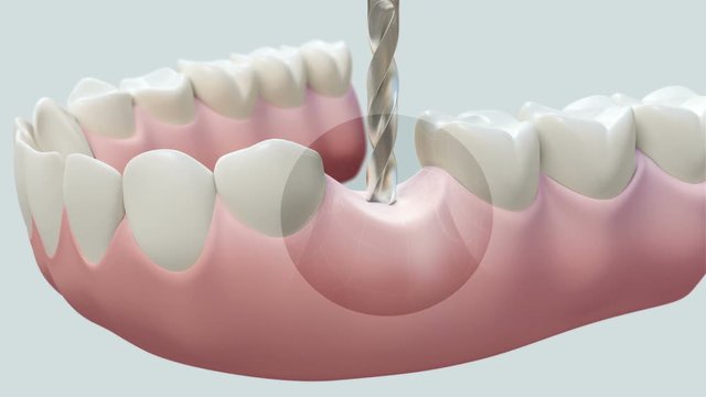 Dental Implant Bright. High quality animation 3D showing the installation process of dental implants.