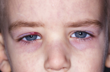 Eye diseases. Closed kid eye with sty