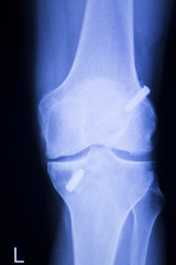 Knee joint implant xray