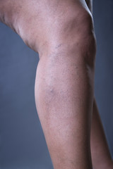 Fototapeta na wymiar Varicose veins closeup, thick female legs
