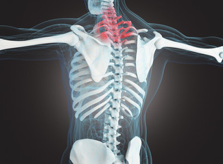 Scheletro osseo con frattura al collo o colpo di frusta
