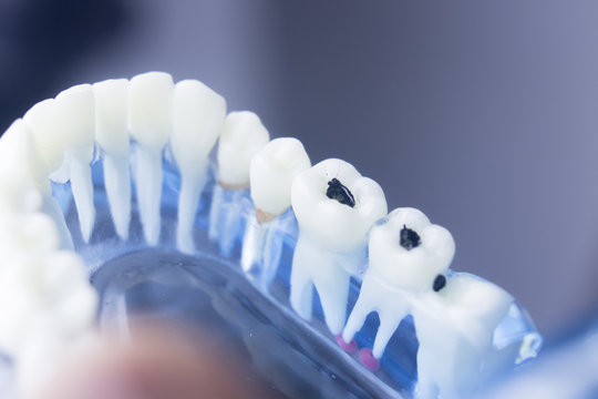 Dental teeth decay plaque model