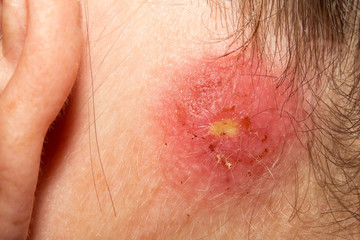 Staph Infection behind ear on mature woman