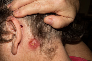Staph Infection on mature woman behind ear