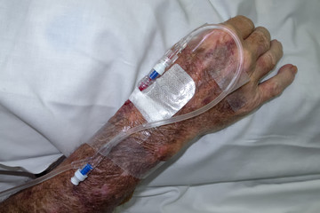 Senior man with canula in arm