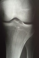 X-ray of human knee joint (model-released)