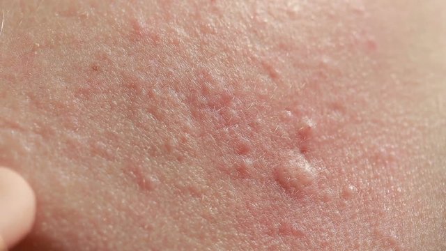 spherical cystic acne on the skin. Close-up. The concept of dermatology