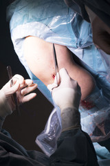Surgical operation knee surgery