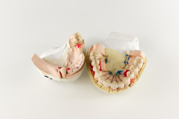 the denture made of ceramics located on plaster model