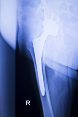 Naklejka premium Hip joint replacement xray
