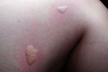 Fototapeta premium Scratch the itchy skin ,Allergy need health care and medicine. Redness of the skin by Mosquito bite