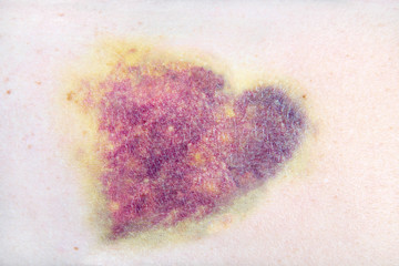 Closeup of a heart shaped bruise