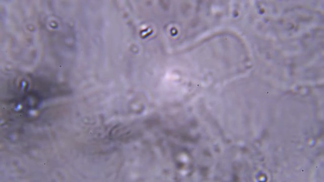 Analysis of the male sperm, the search for active sperm for diagnosis. One was found, using a microscope at extreme magnification of about 1000x - there is hope :)