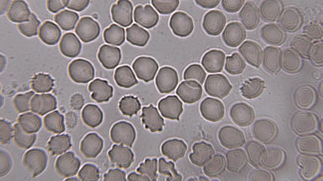 Footage on the theme blood, diseases, interstitial fluid, bacterial background, research using a microscope at extreme magnification of about 1000x