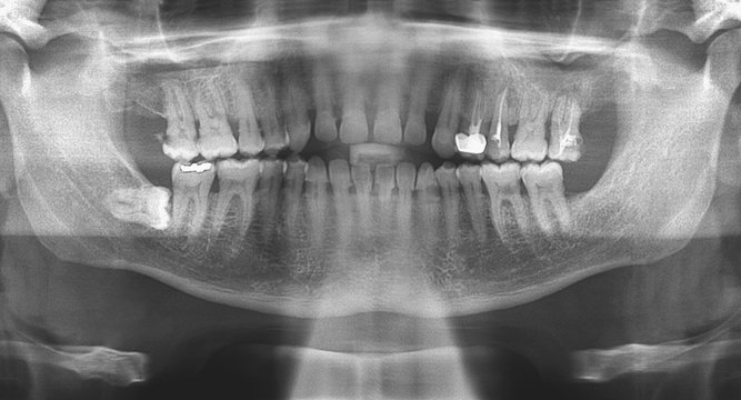 dental panoramic radiograph