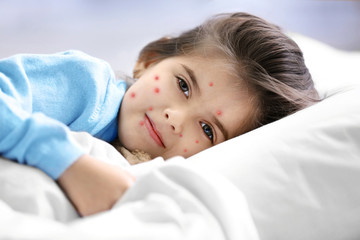 Little girl with red pimples lying in bed at home. Chicken pox concept