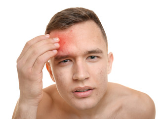 Fototapeta premium Skin care concept. Young man with acne on white background