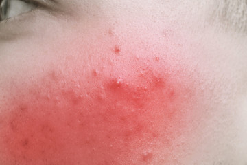 Acne treatment concept. Skin irritation, closeup