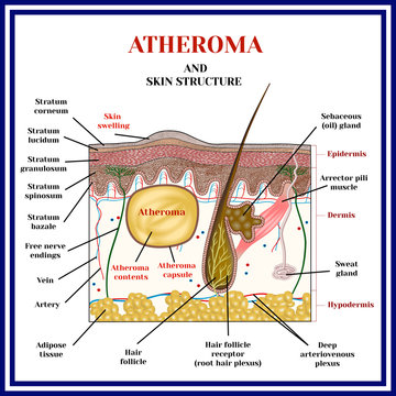 Atheroma. Cysts, tumors. Skin structure. Obstruction of the sebaceous gland.