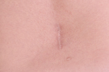 Back scar tissue after herniated disc surgery