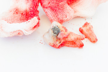 decayed tooth with bloody gauze pad on white background