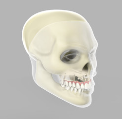 3D rendering implant