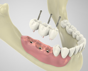 3D rendering implant
