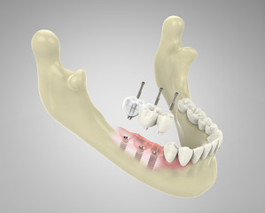 3D rendering implant