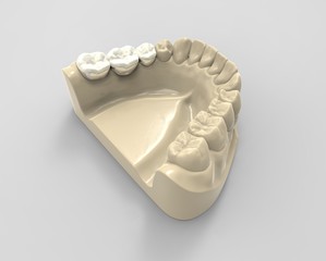 3D rendering dentures