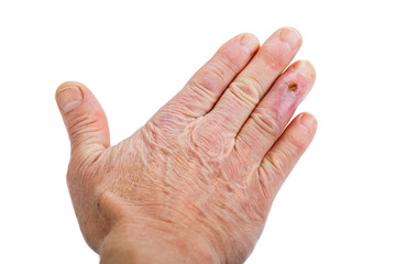 Postoperative scar on the fourth finger