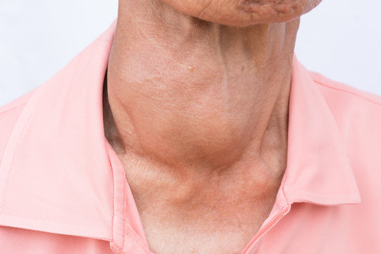 Woman with enlarged hyperthyroid gland. Hyperthyroidism symbol.