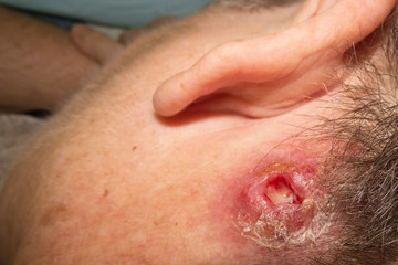 Severe staph infection behind ear of mature woman
