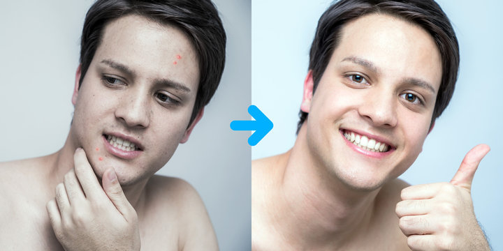 men's pimple treatment before after image, acne treatment, men's skin care